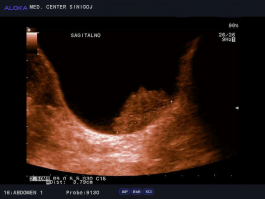 Ultrazvok mehurja - tumor mehurja, 4cm